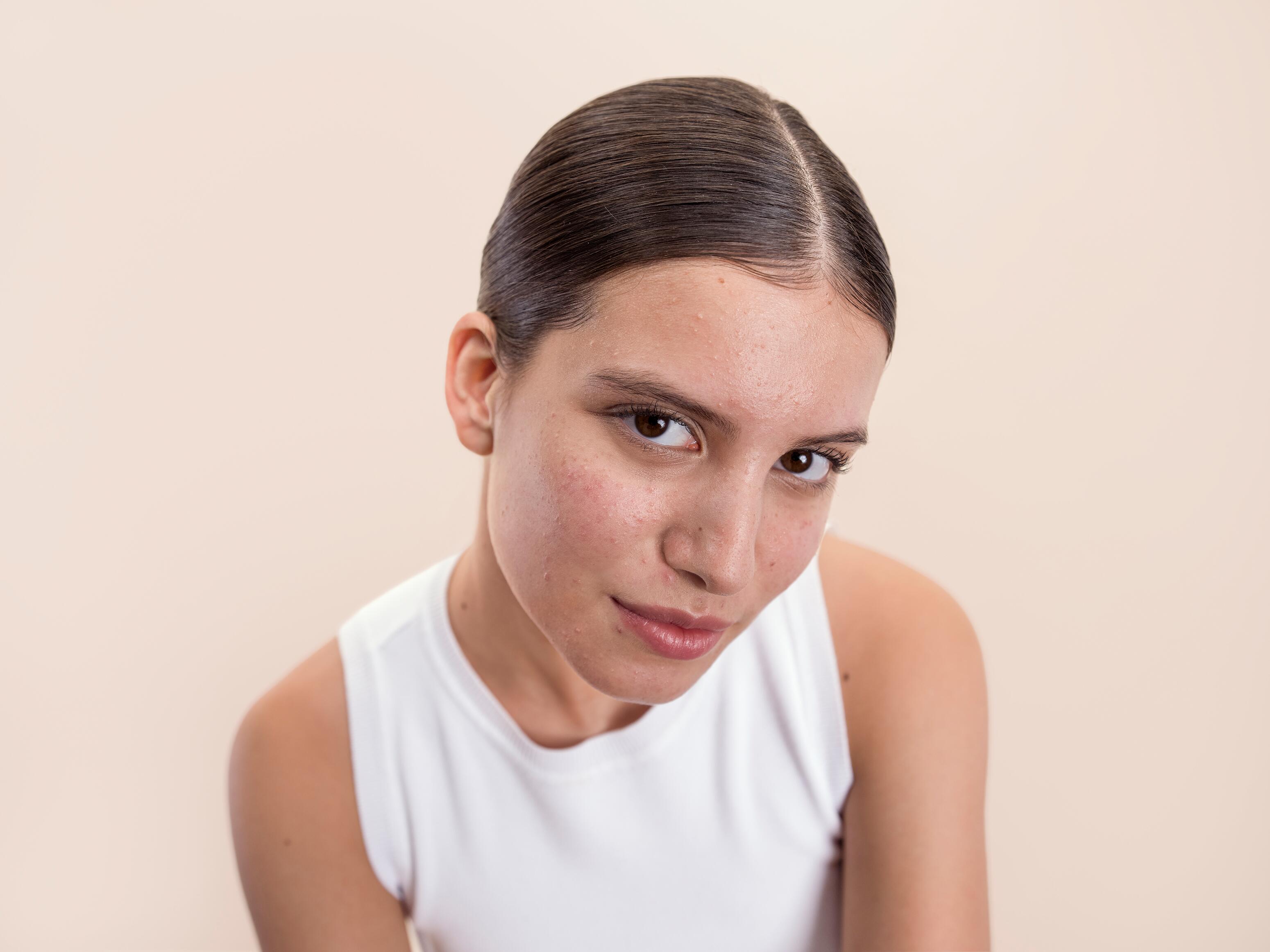 Qu'est-ce que l'acné hormonale ?